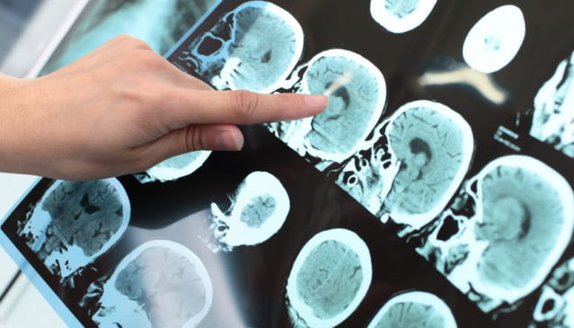 léčba Alzheimerova choroba