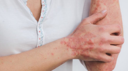 Psoriáza (nebo také lupénka, latinsky psoriasis vulgaris)
