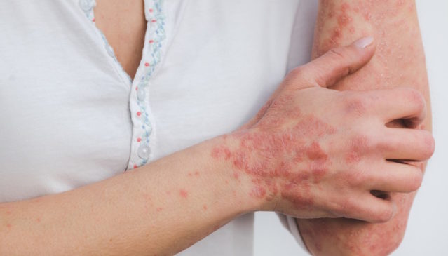 Psoriáza (nebo také lupénka, latinsky psoriasis vulgaris)
