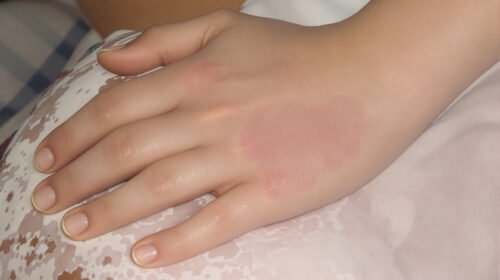 Atopická dermatitida