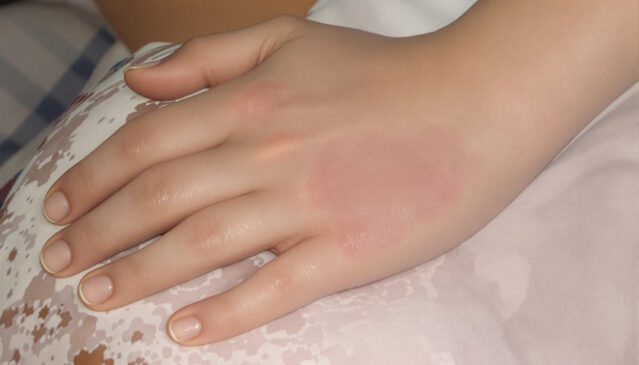 Atopická dermatitida